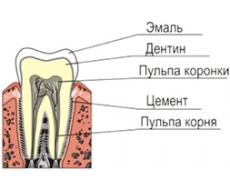 Кариес